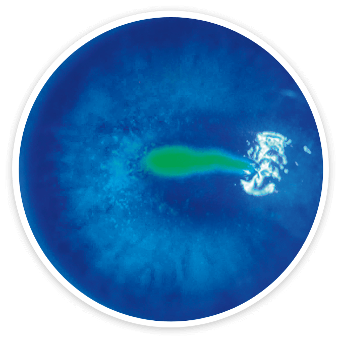 Fluorescein staining of an eye with Stage 2 (moderate) neurotrophic keratitis (NK) at baseline, as seen under cobalt blue light