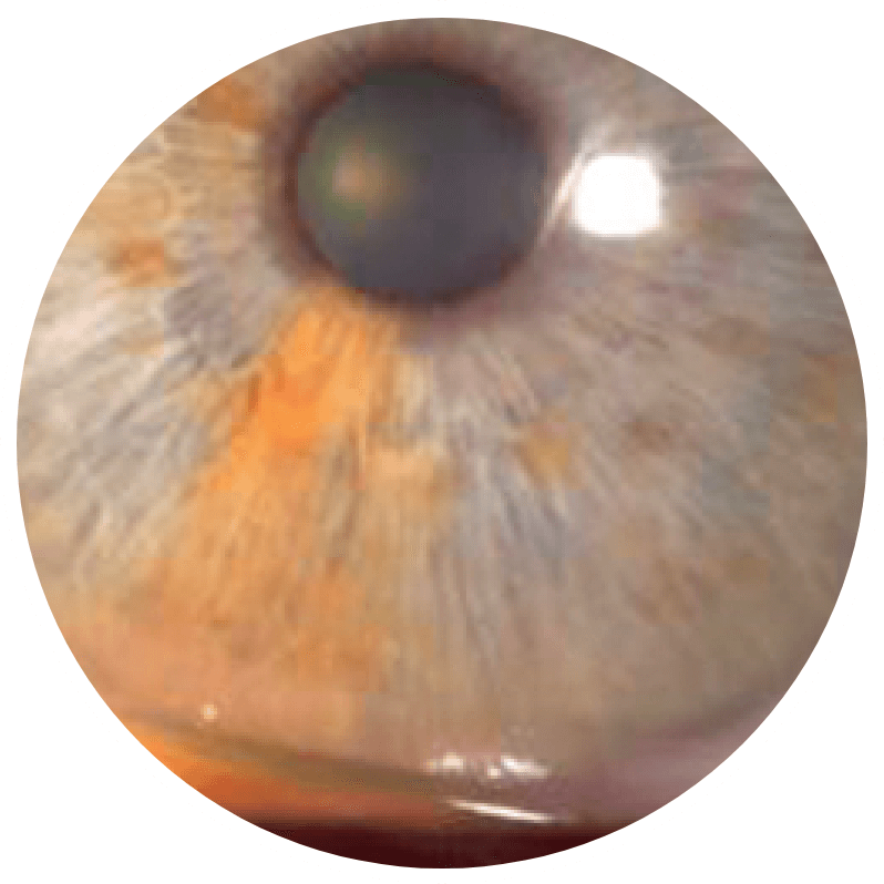 An eye with stage 1 (mild) neurotrophic keratitis (NK) as seen under diffuse white light