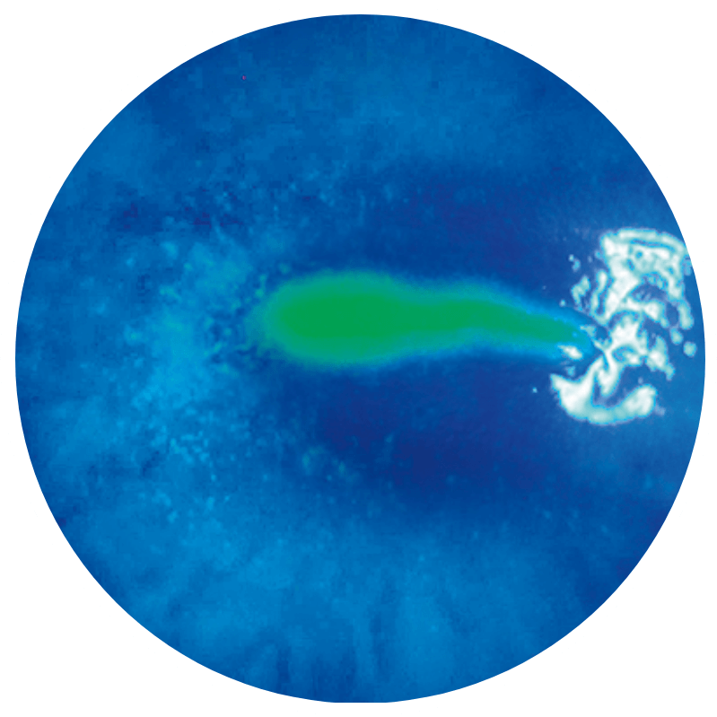 Fluorescein staining of an eye with stage 2 (moderate) neurotrophic keratitis (NK) as seen under cobalt blue light