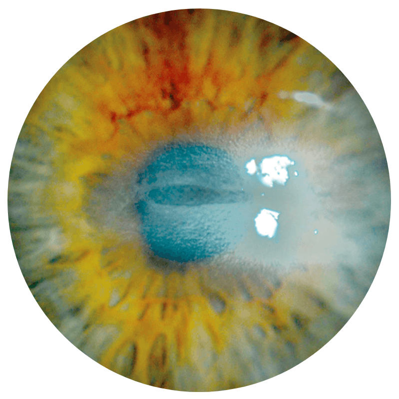 An eye with stage 2 (moderate) neurotrophic keratitis (NK) as seen under diffuse white light