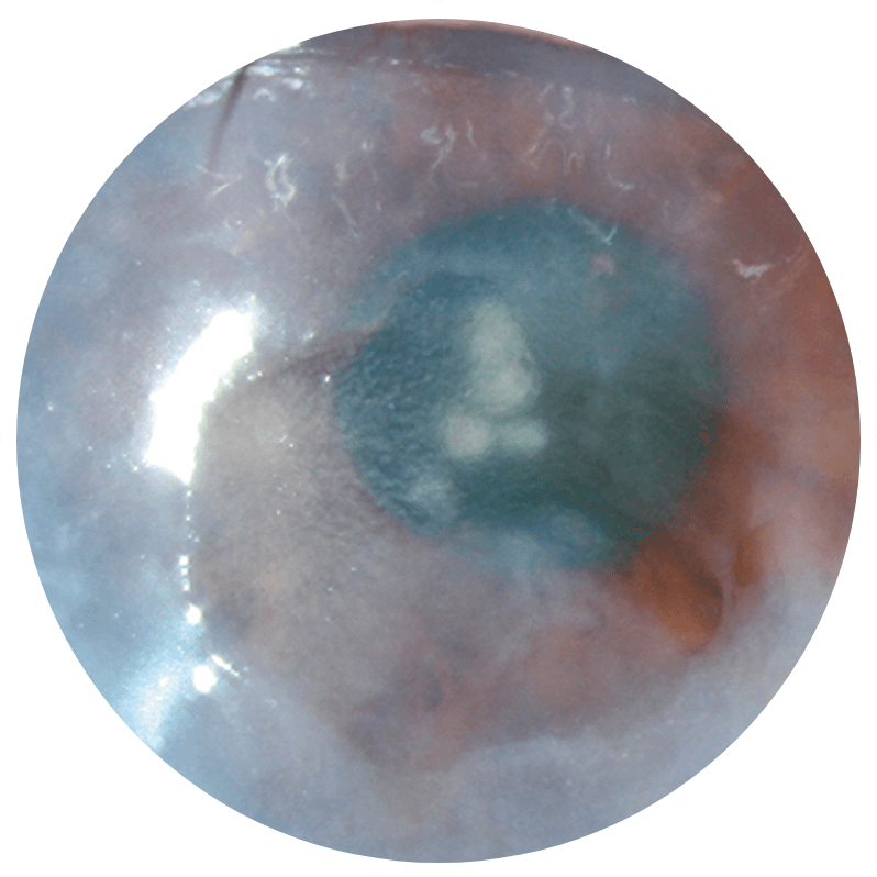 An eye with stage 3 (severe) neurotrophic keratitis (NK) as seen under diffuse white light